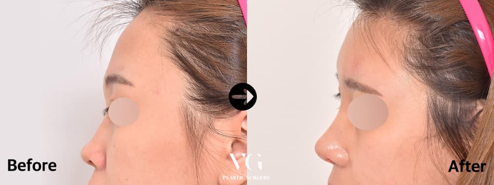 Side profile before and after rhinoplasty: a low, short-looking nose on the left, a higher bridge and a more defined tip on the right