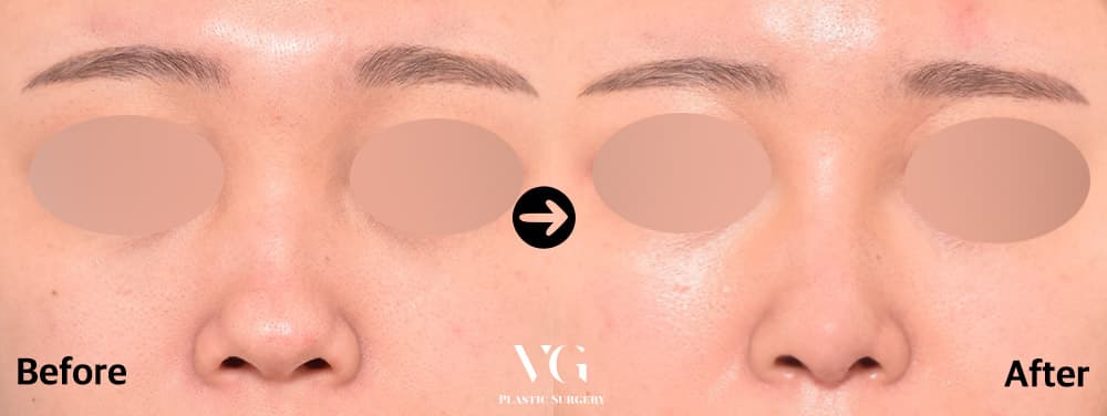 Front view of the lower nose before and after rhinoplasty: the bridge reads straighter and the tip slightly narrower above the nostrils