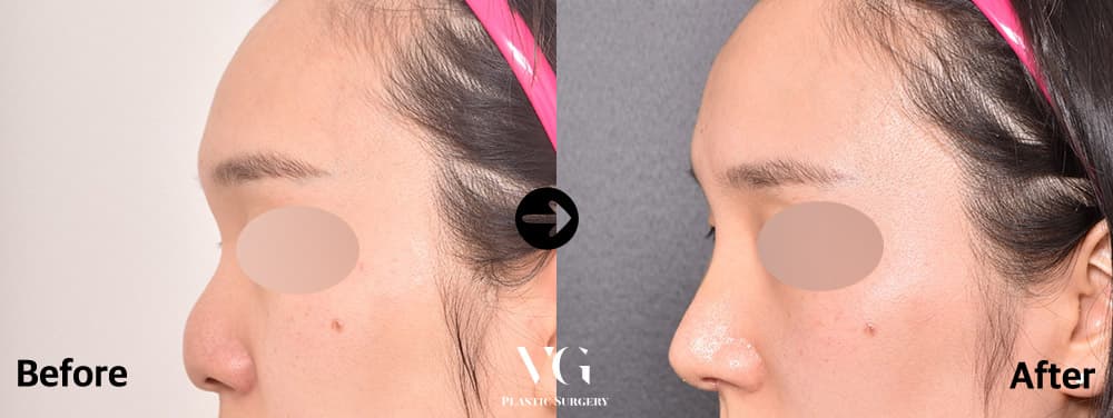 Side profile before and after hump correction: the bump on the upper bridge is gone and the line from forehead to tip is straight