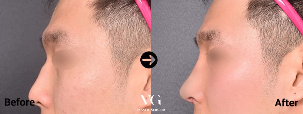Male side profile before and after: a bump on the upper bridge and a low tip become one straight line with a lifted, defined tip