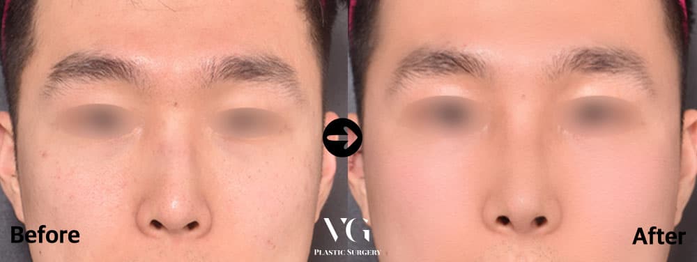 Male front view before and after crooked-nose correction: a bridge leaning to one side now runs down the centre of the face