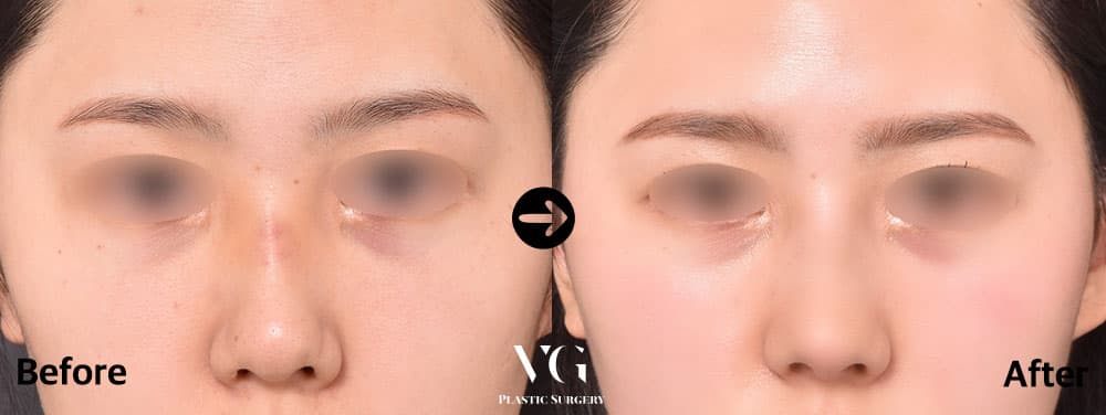 Front view before and after bridge and tip augmentation: a flat, wide-looking bridge becomes a narrower, clearly defined line