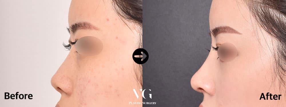 Side profile before and after bridge augmentation: a low, flat bridge on the left, a higher and straighter line to the tip on the right