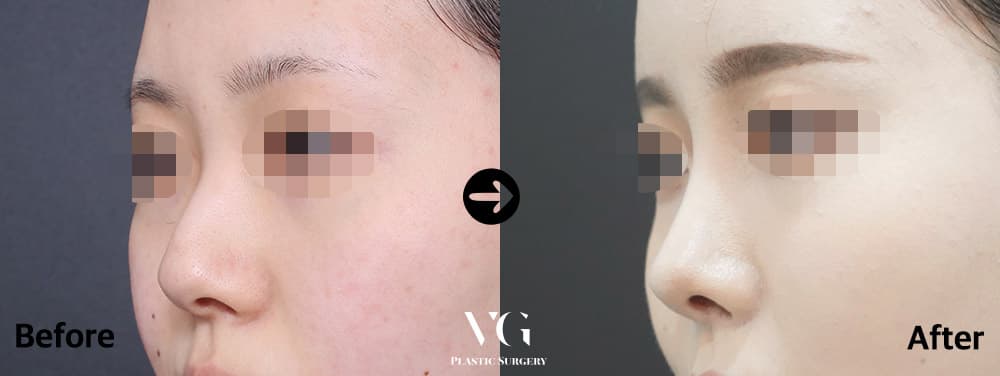 코성형 + 매부리 교정 + 복코 교정
