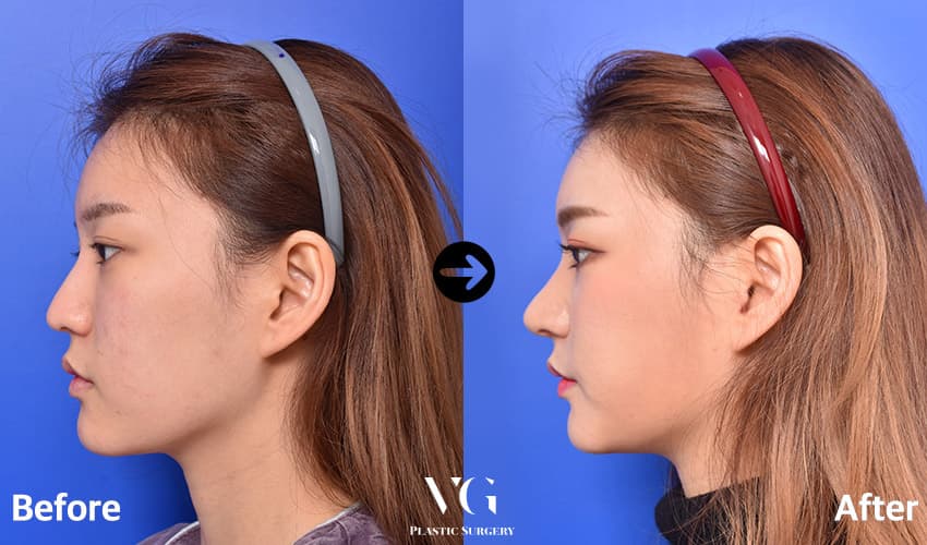Side profile before and after: a low, soft nose becomes higher along the bridge with a more projected, defined tip
