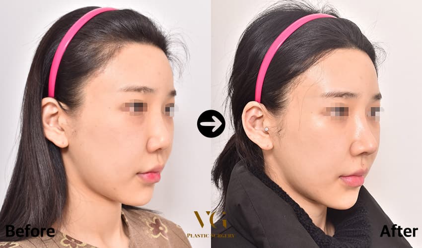 코 재수술 + 기증늑연골