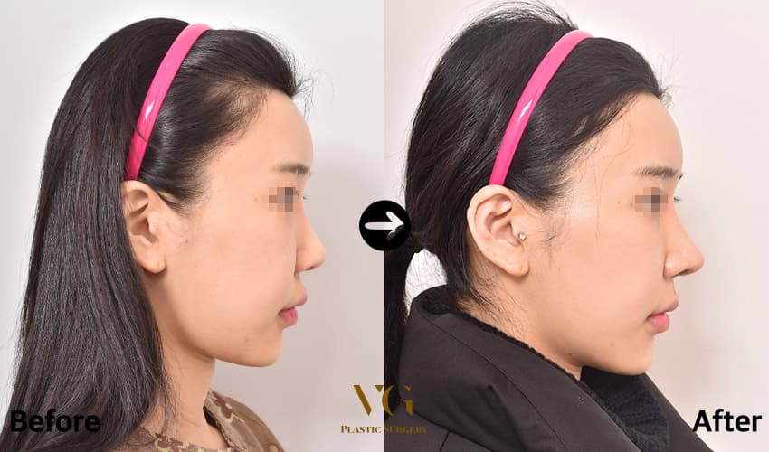 女性の右横顔の提供肋軟骨による鼻再手術の術前術後比較。術前は鼻筋が低く鼻先が上向きだが、術後は鼻筋がまっすぐ通り鼻先が下へ伸びている