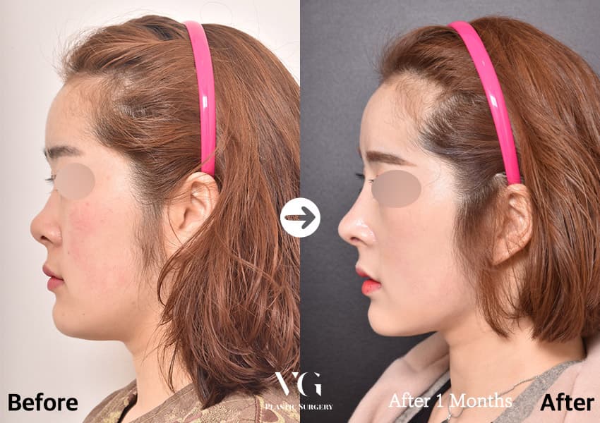 ภาพด้านข้างก่อนและหลังผ่าตัดจมูกด้วยกระดูกอ่อนซี่โครงบริจาค สันจมูกสูงขึ้นและปลายจมูกยื่นออกมาชัดกว่าเดิม