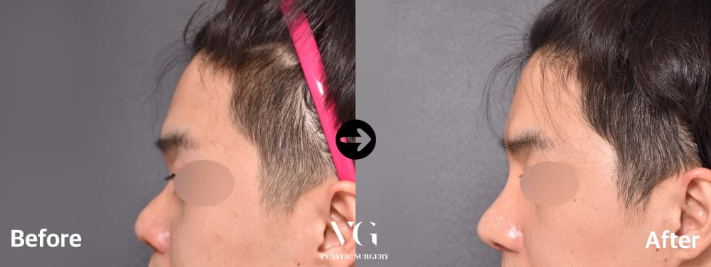 Side profile of a man before and after short-nose correction with donor rib cartilage: the upturned tip is lengthened and projects forward