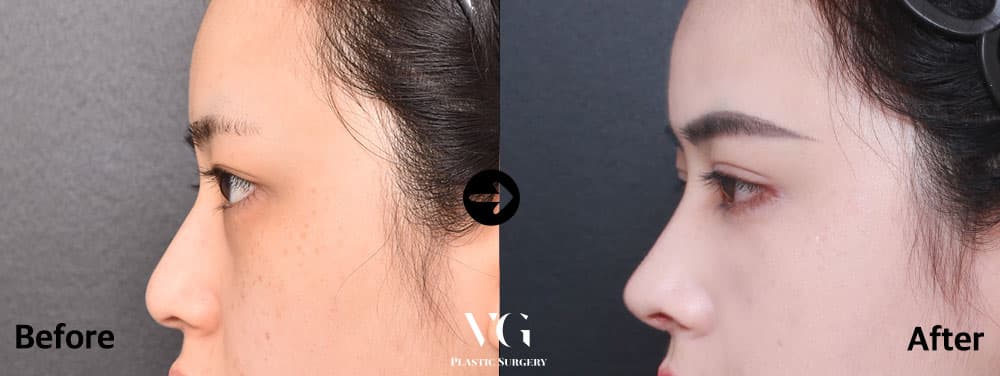 Side profile before and after tip surgery: a rounded, low tip on the left, a slimmer tip that projects further on the right