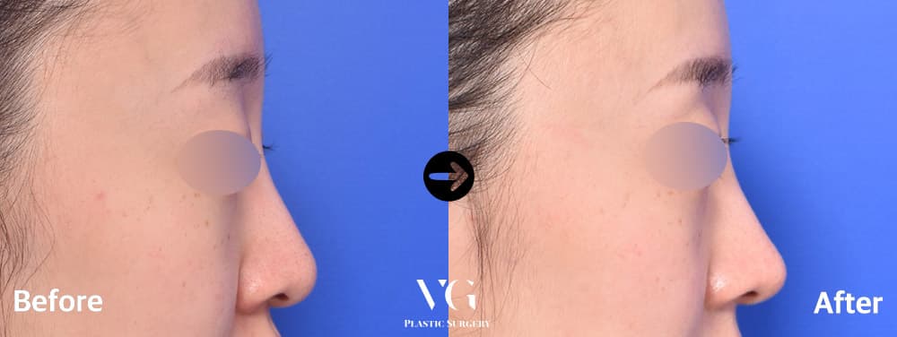 Side profile before and after tip surgery with nostril reduction: the lower nose sits slimmer and the tip line is more refined