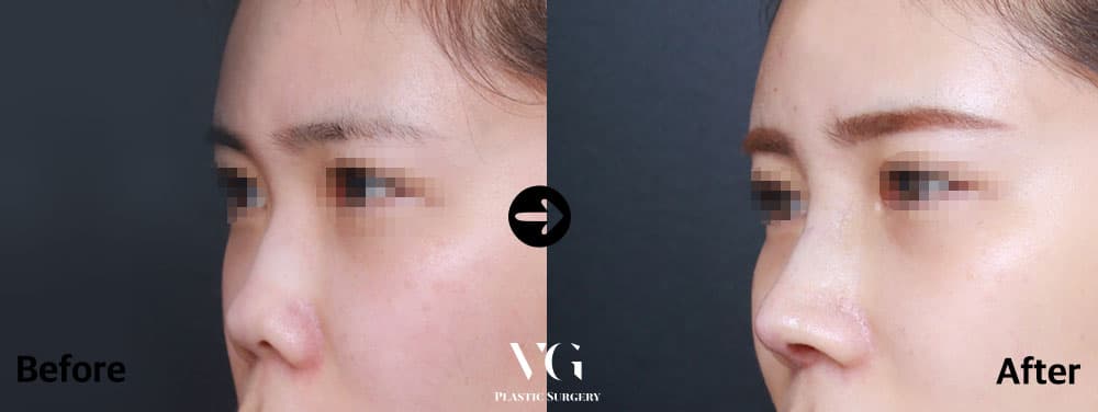 เสริมจมูก + แก้ไขจมูกสั้น + กระดูกอ่อนซี่โครงตนเอง