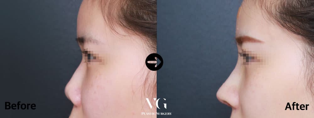 Side profile before and after short nose lengthening: a short nose with a lifted tip becomes longer, with a higher bridge and a forward-pointing tip