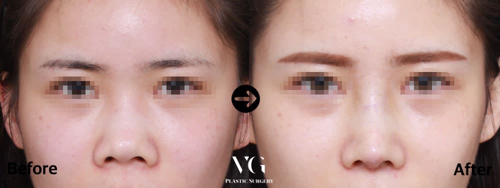 Front view of the same patient: the nostrils are less visible after surgery and the bridge line reads more clearly between the eyes