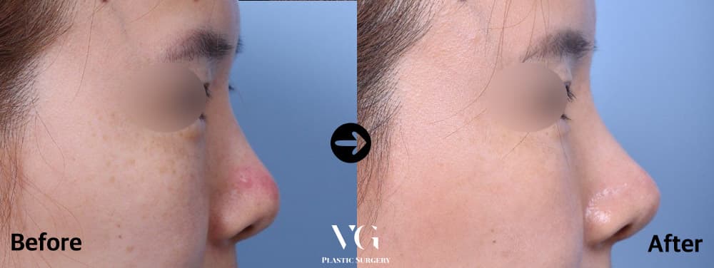 Side profile before and after revision for a lifted tip: the reddened, upward-pointing tip on the left sits lower and longer on the right
