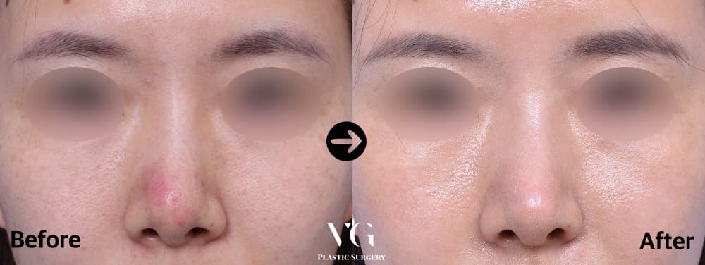 Front view before and after revision of a lifted tip: a red, upturned tip with visible nostrils becomes a lower tip with less nostril show