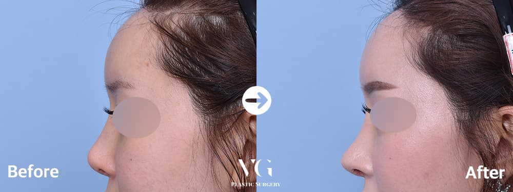 Side profile before and after revision rhinoplasty: the bridge line runs straighter and the tip sits slightly higher