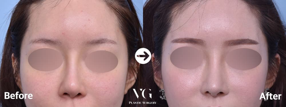Front view before and after revision rhinoplasty: a wide, flat-looking bridge becomes a narrower, more defined line