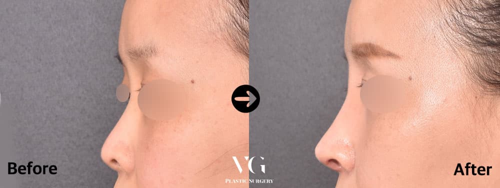 Female side profile before and after revision with own rib cartilage: a low, short bridge with a rounded tip becomes a longer, higher line