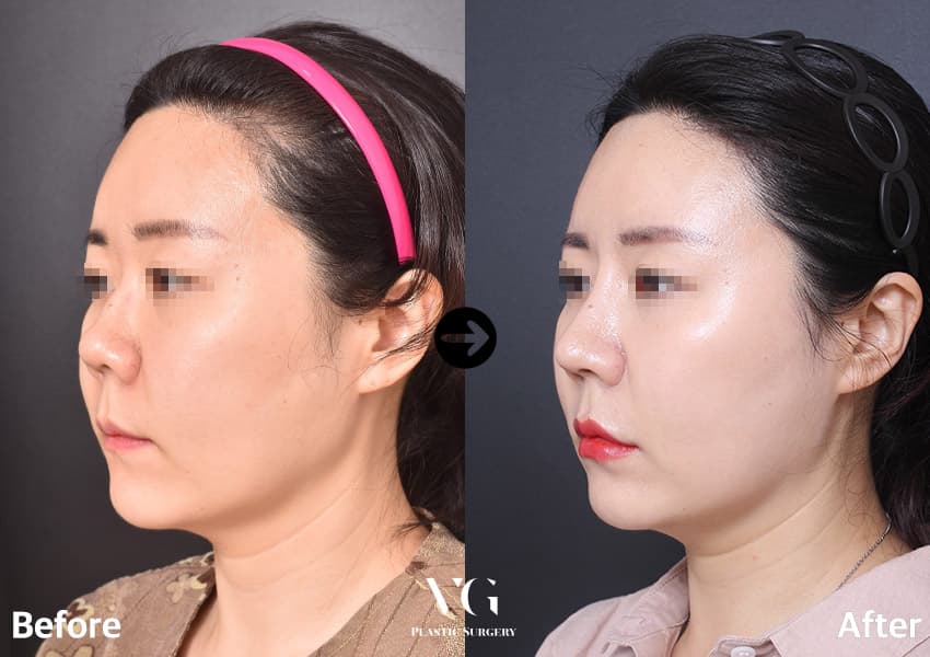 코성형 + 짧은코 교정 + 매부리 교정