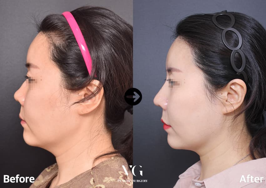 Female side profile before and after short-nose correction with hump correction: the tip sits further forward and the nose looks longer
