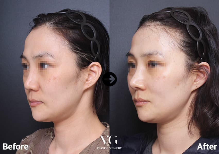 ผ่าตัดจมูกแก้ไข — มุมที่ 1