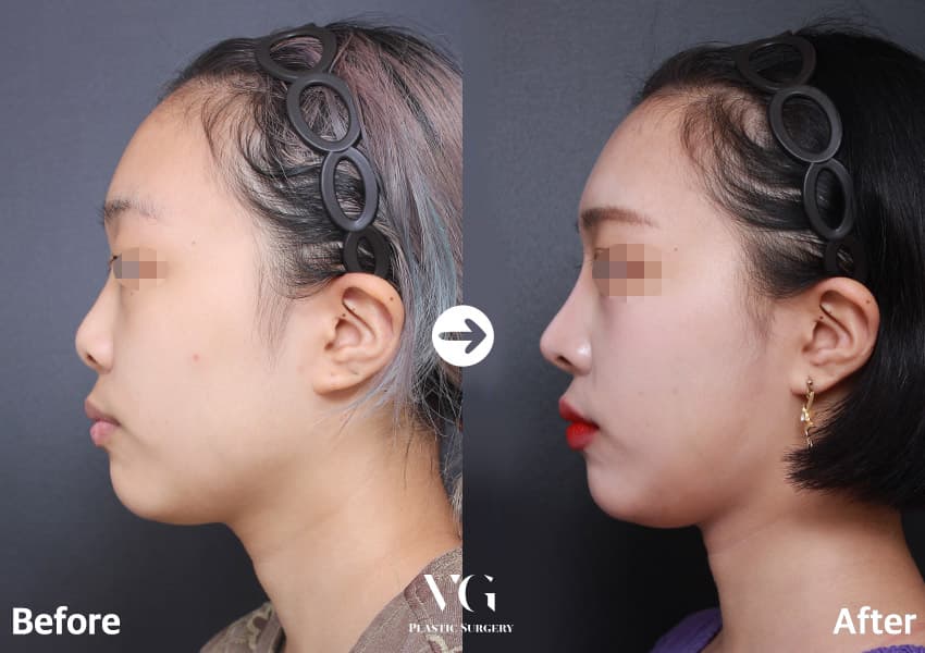 ภาพด้านข้างก่อนและหลังศัลยกรรมจมูก 3 เดือน สันจมูกที่เคยต่ำสูงขึ้นและปลายจมูกยื่นออกมาชัดขึ้น