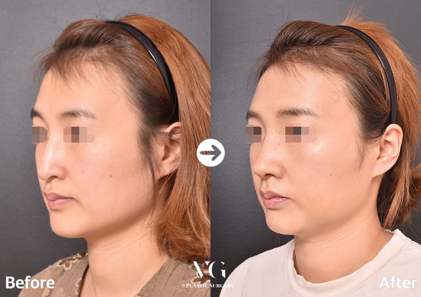 코끝성형 + 매부리 교정 + 절골술