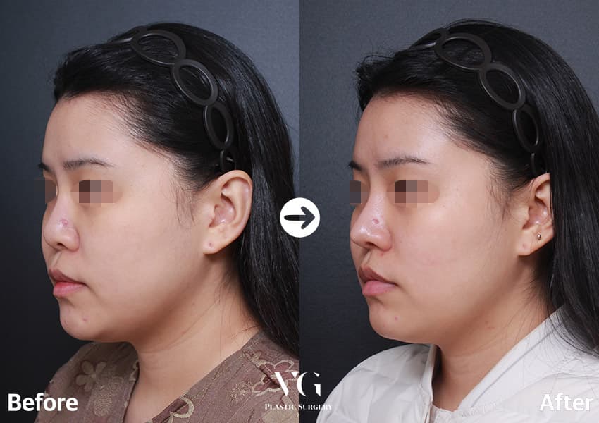 ผ่าตัดจมูกแก้ไข + กระดูกอ่อนซี่โครงตนเอง