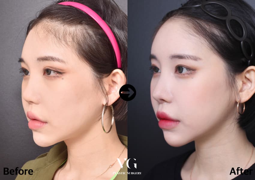 코 재수술 + 기증늑연골