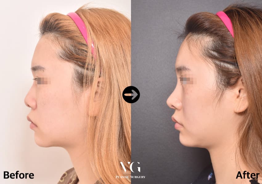 女性の左横顔の提供肋軟骨による鼻再手術の術前術後比較。術前は鼻が短く上を向いているが、術後は鼻根が高くなり鼻が長く見える