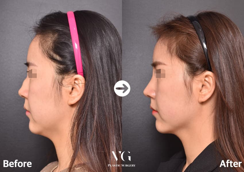 ภาพด้านข้างก่อนและหลังศัลยกรรมจมูก 3 เดือน สันจมูกต่อเนื่องขึ้น ปลายจมูกชัดและยกขึ้นเล็กน้อย รับกับริมฝีปากและคาง