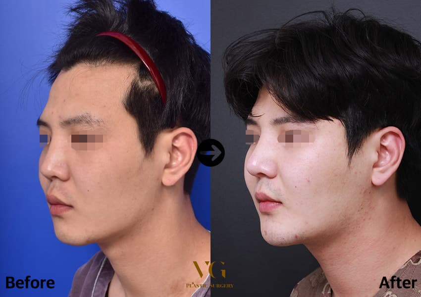 เสริมจมูก + กระดูกอ่อนซี่โครงตนเอง + ลดโหนกแก้ม — มุมที่ 1