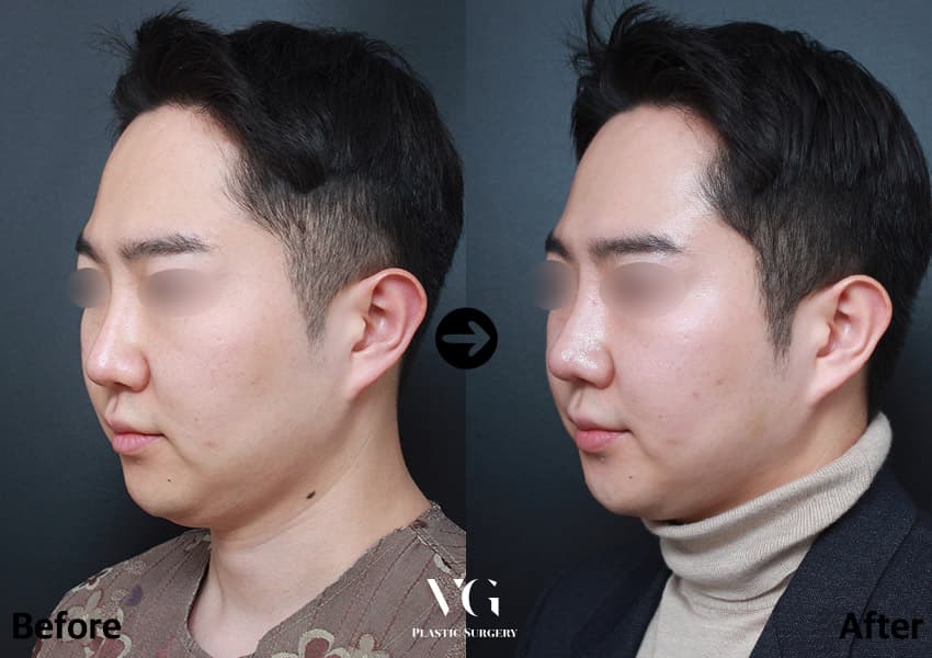코성형 전후 비교 · 케이스 753