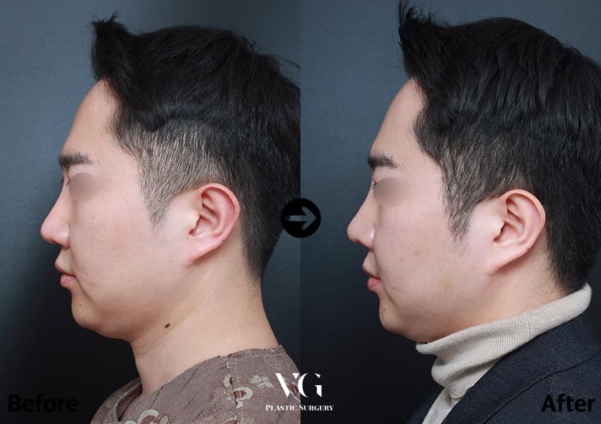 ภาพด้านข้างเต็มใบหน้าผู้ชายก่อนและหลังผ่าตัดจมูกด้วยกระดูกอ่อนซี่โครงของตัวเอง 3 เดือน สันจมูกสูงขึ้นเข้ากับหน้าผากและคาง