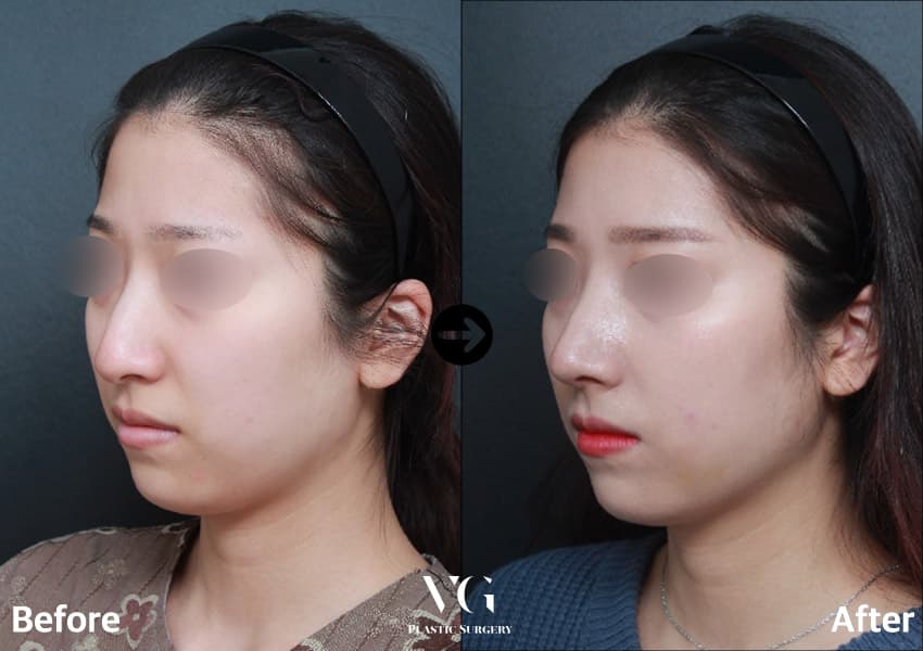 코끝성형 + 매부리 교정 + 절골술