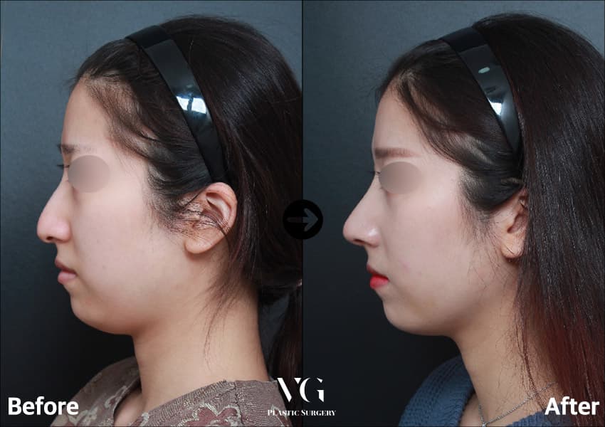Female side profile before and after hump correction and tip surgery: the bump on the bridge is gone and the line from forehead to tip is straight