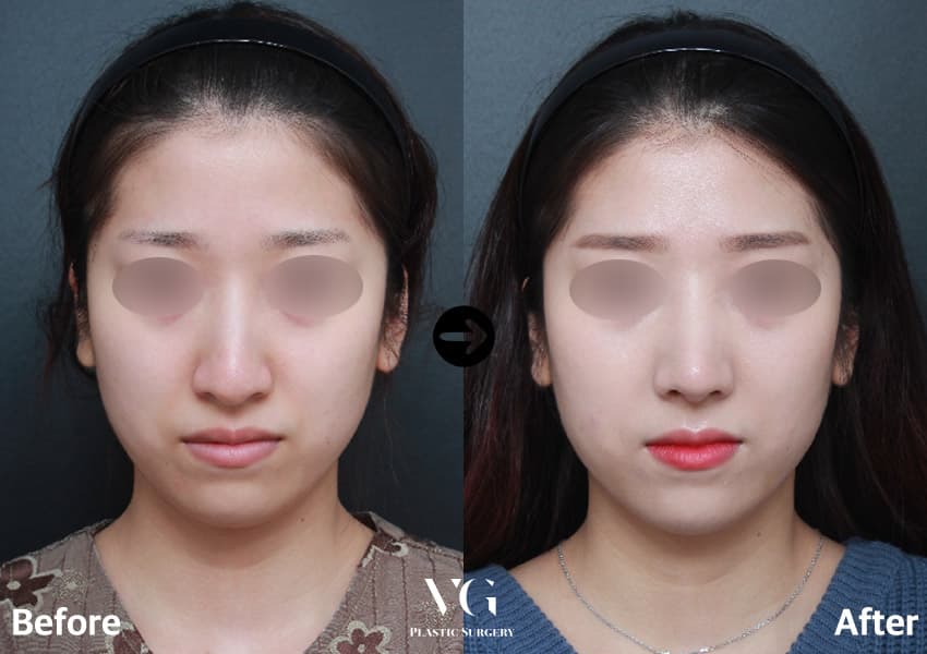 Female front view before and after tip surgery with osteotomy: the bony bridge looks narrower and the tip more defined, with lipstick in the after