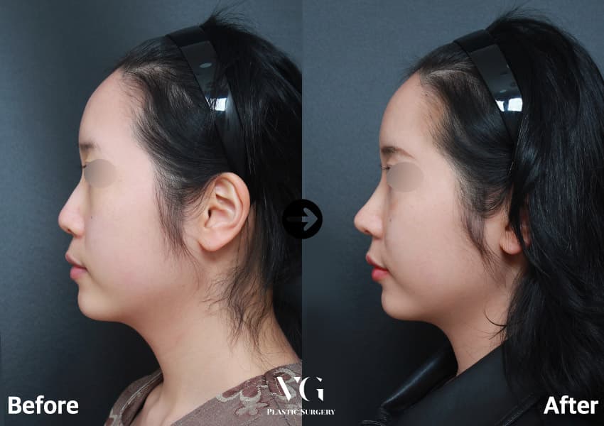 ภาพด้านข้างก่อนและหลังผ่าตัดปลายจมูก 3 เดือน ปลายจมูกที่เคยกลมใหญ่และต่ำดูเล็กลง ชัดขึ้น และยื่นออกมาเป็นทรงมน
