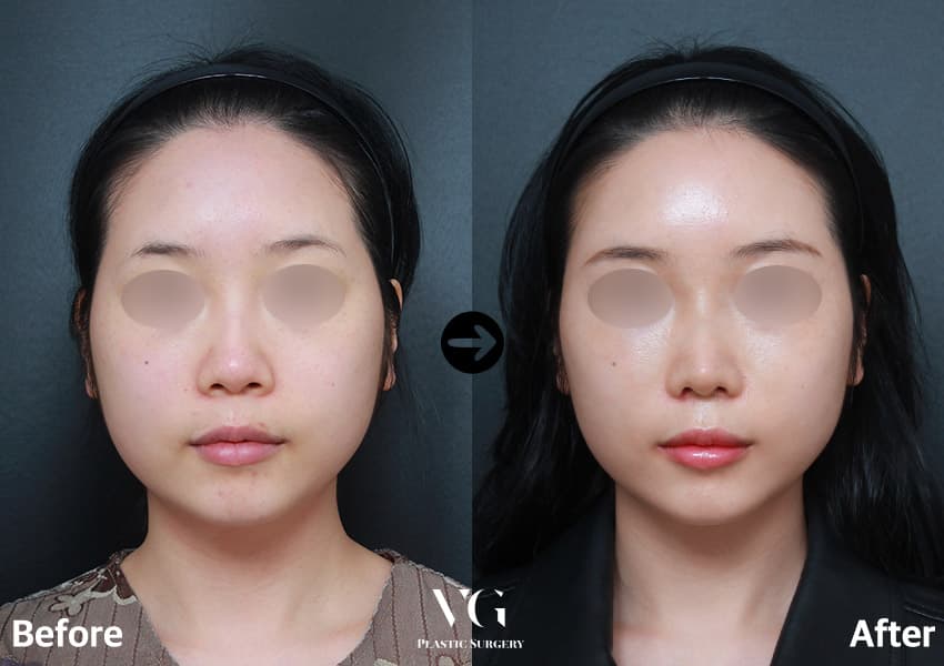 Front view before and after tip surgery with nostril reduction: the round tip is slimmer and the nostrils no longer flare past it