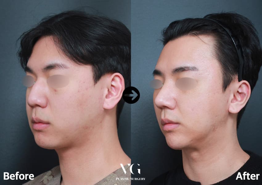 코끝성형 + 매부리 교정 + 절골술