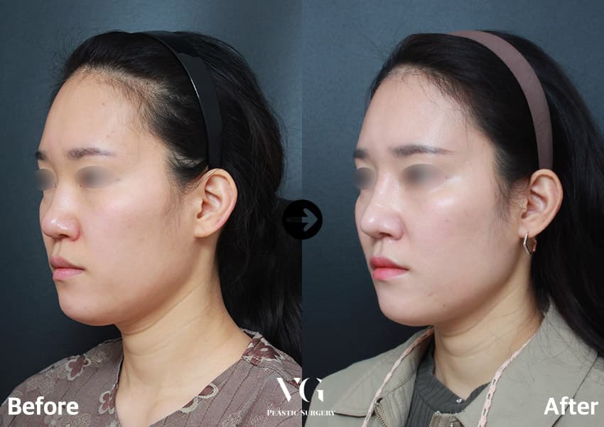 กระดูกอ่อนซี่โครงบริจาค + แก้ไขปลายจมูกบาน + ผ่าตัดลดขนาดเยื่อบุจมูก +1