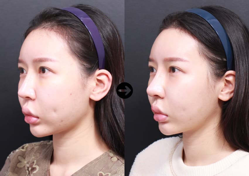 ผ่าตัดจมูกแก้ไข + กระดูกอ่อนซี่โครงตนเอง + ลดปีกจมูก +3