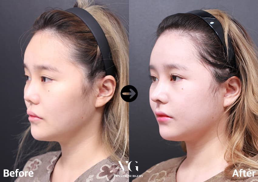ผ่าตัดจมูกแก้ไข + กระดูกอ่อนซี่โครงตนเอง + ผ่าตัดลดขนาดเยื่อบุจมูก