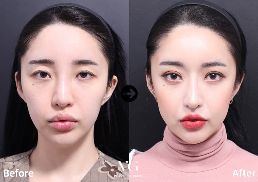 ลดโหนกแก้ม + เสริมจมูก + กระดูกอ่อนซี่โครงตนเอง +5