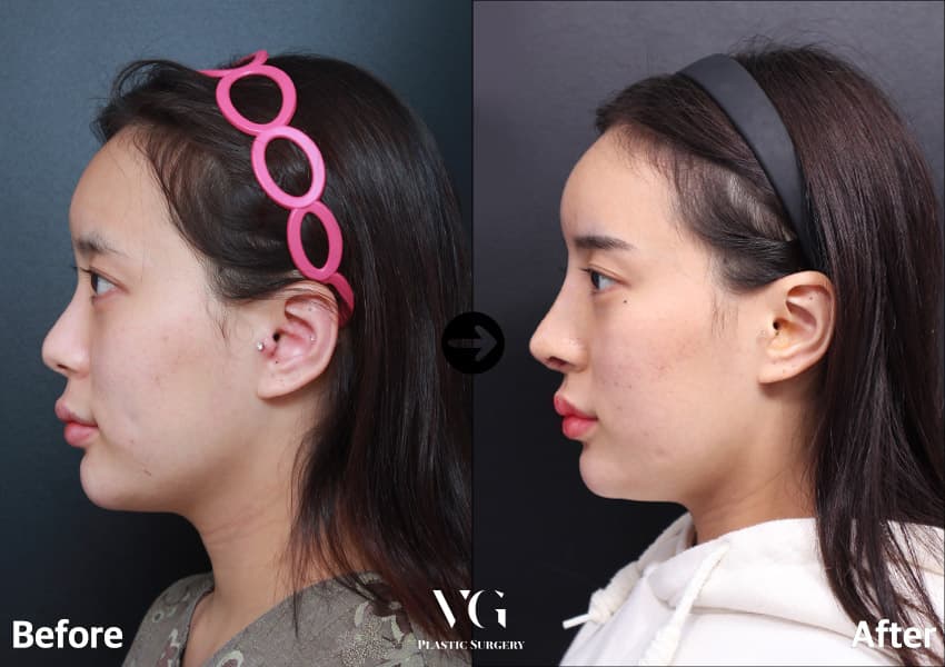 Side profile before and after rhinoplasty with donor rib cartilage: a low bridge becomes a higher, straight line from forehead to tip
