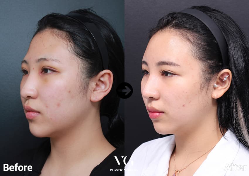 เสริมจมูก + ผ่าตัดกระดูกจมูกให้แคบลง + ตาสองชั้นแบบธรรมชาติ +1