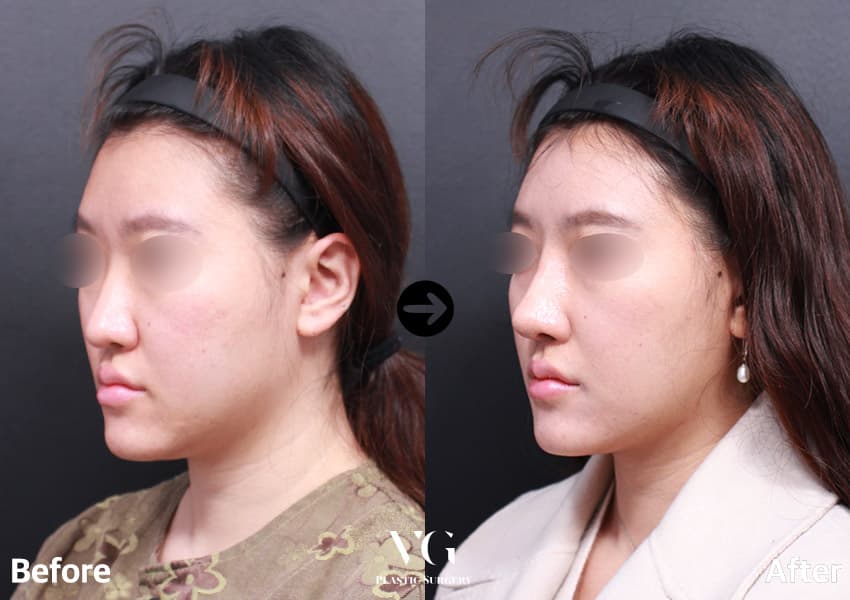 코성형 + 비중격교정술 + 하비갑개 수술 — 각도 1