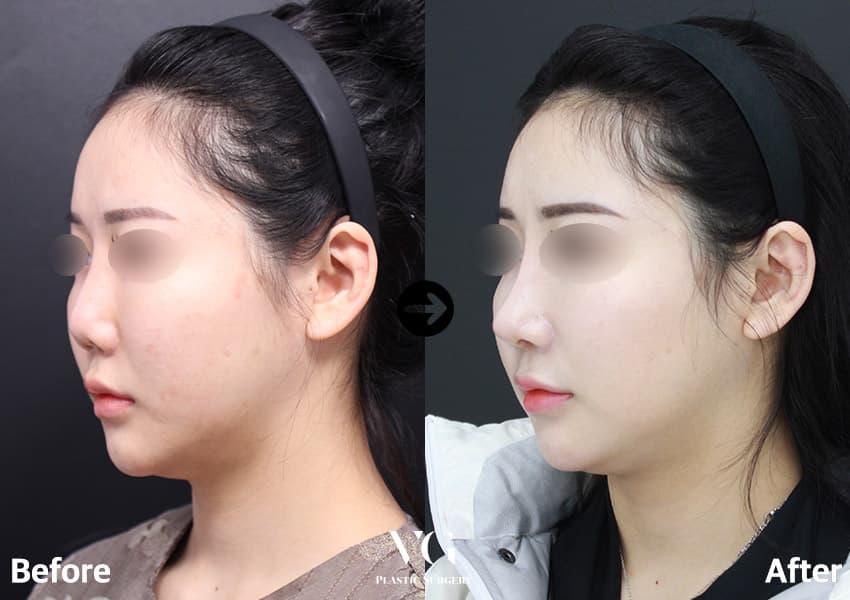 ผ่าตัดจมูกแก้ไข + กระดูกอ่อนซี่โครงตนเอง — มุมที่ 1