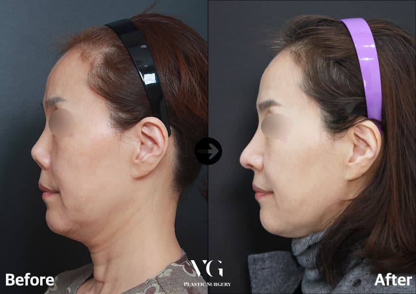中年女性の左横顔の自家肋軟骨による鼻再手術の術前術後比較。術前は鼻が短く鼻筋が低いが、術後は鼻筋が高くなり鼻先が前方へ伸びている